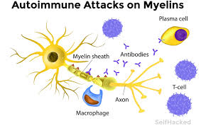 Autoimmune attack on myelin in MS