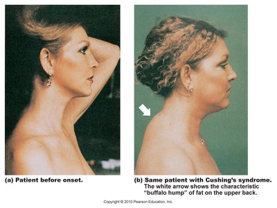 Cushing's syndrome: buffalo hump