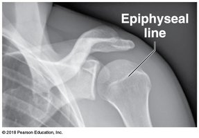 Epiphyseal line in adult bone (x-ray)