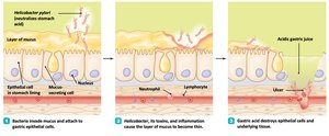 Pathogenesis of Helicobacter pylori and ulcer formation