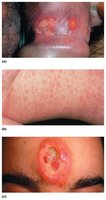 Clinical manifestations of syphilis (chancre, rash, gumma)