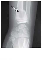 Colles fracture