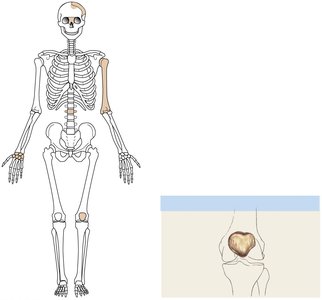 Sesamoid bone (patella)