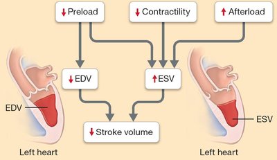 Diagram showing effects of decreased preload, contractility, and increased afterload on stroke volume