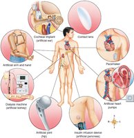 Examples of prosthetic devices and organ replacements