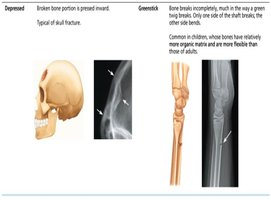 Table of depressed and greenstick fractures