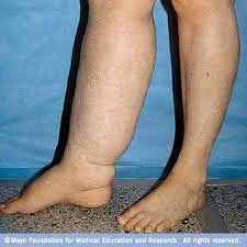 Clinical image of lymphedema in the leg