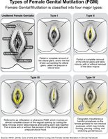 Types of female genital mutilation