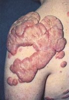Keloid scar tissue