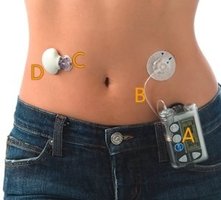 Insulin pump for diabetes management