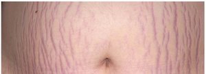 Stretch marks (striae) on the abdomen