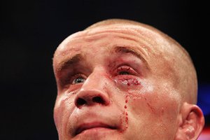 Hematoma: bruise on the face