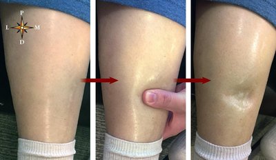 Clinical Application: Edema