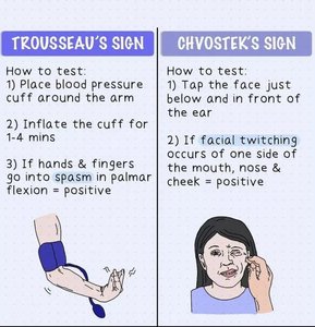 Trousseau's and Chvostek's signs for hypocalcemia