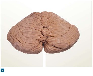 Posterior, superior surface of the cerebellum (alternate view)