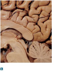 Sagittal section showing hypothalamus and pineal gland