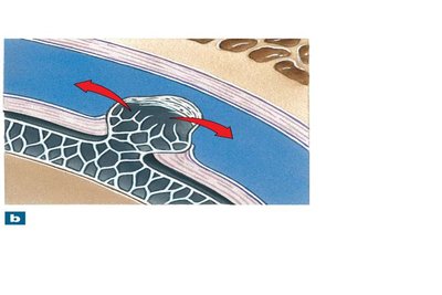 Arachnoid granulations and CSF absorption