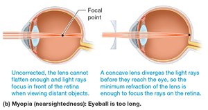 Myopia (nearsightedness)