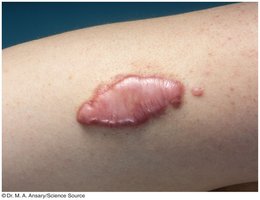 Keloid scar