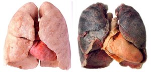Healthy vs. diseased lungs