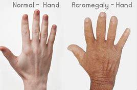Gigantism