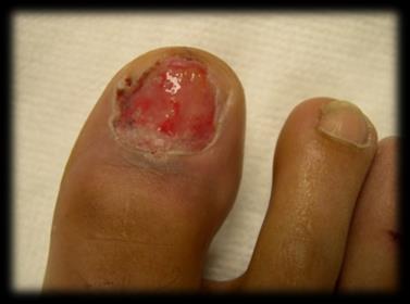 Example of tissue injury activating nociceptors