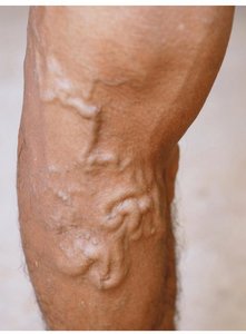 Varicose veins in the leg