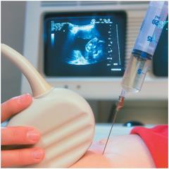 Amniocentesis procedure