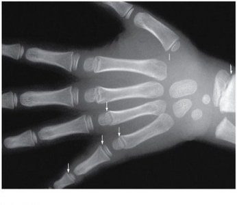 X-ray of hand showing epiphyseal plates