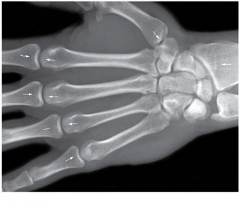 X-ray of hand showing epiphyseal lines