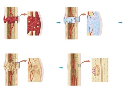 Bone repair process