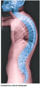 Examples of abnormal spinal curvatures