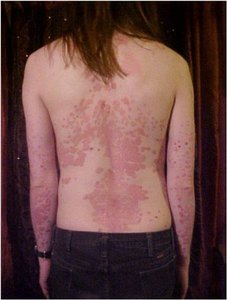 Psoriasis: chronic skin disease with scaly patches
