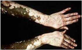 Vitiligo: patchy loss of skin pigment