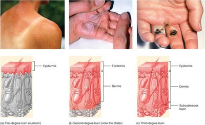 Degrees of burns: first, second, third