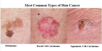 Most common types of skin cancer: melanoma, basal cell carcinoma, squamous cell carcinoma