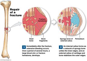 Repair of a fracture: hematoma, callus formation, and bone remodeling.