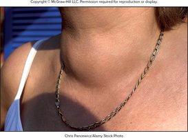 Photograph of a person with goiter (enlarged thyroid gland)
