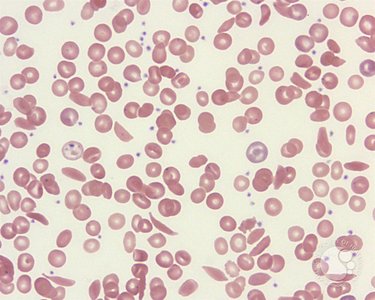 Blood smear showing abnormal erythrocytes in anemia
