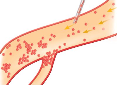 Agglutination of donor RBCs in transfusion reaction