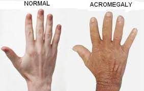 Normal vs. acromegaly hand comparison