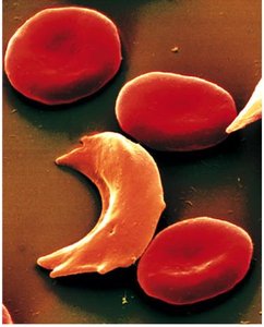 Sickle-cell erythrocyte among normal RBCs
