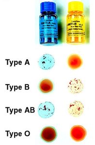 Mismatched transfusion reaction