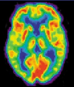 PET scan of the brain