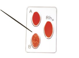 Blood typing card showing agglutination pattern for B- blood