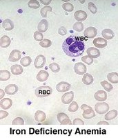 Blood smear showing iron deficiency anemia