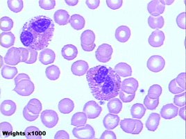 Blood smear showing eosinophilia