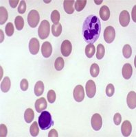 Blood smear showing hypersegmented neutrophil in pernicious anemia