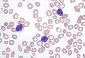 Blood smear showing increased lymphocytes in chronic lymphocytic leukemia