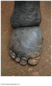 Photograph of a foot with lymphedema (elephantiasis)